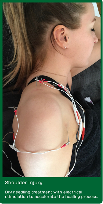 Dry Needling for Shoulder